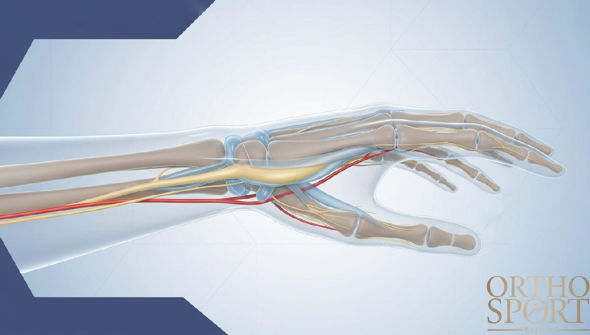 zespół cieśni nadgarstka objawy leczenie – Anatomia nadgarstka z uciskiem nerwu pośrodkowego w kanale.